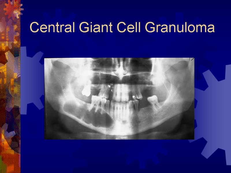 Central Giant Cell Granuloma